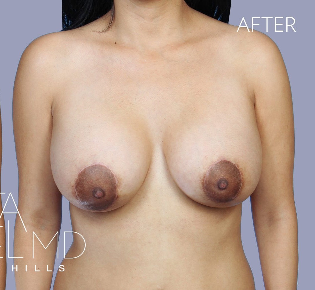 Breast Augmentation with Lift before and after - after