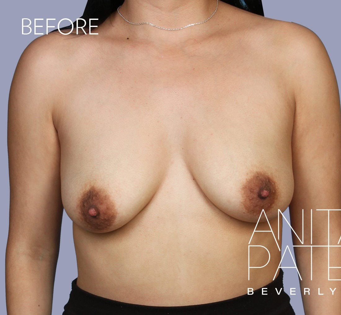 Breast Augmentation with Lift before and after - before