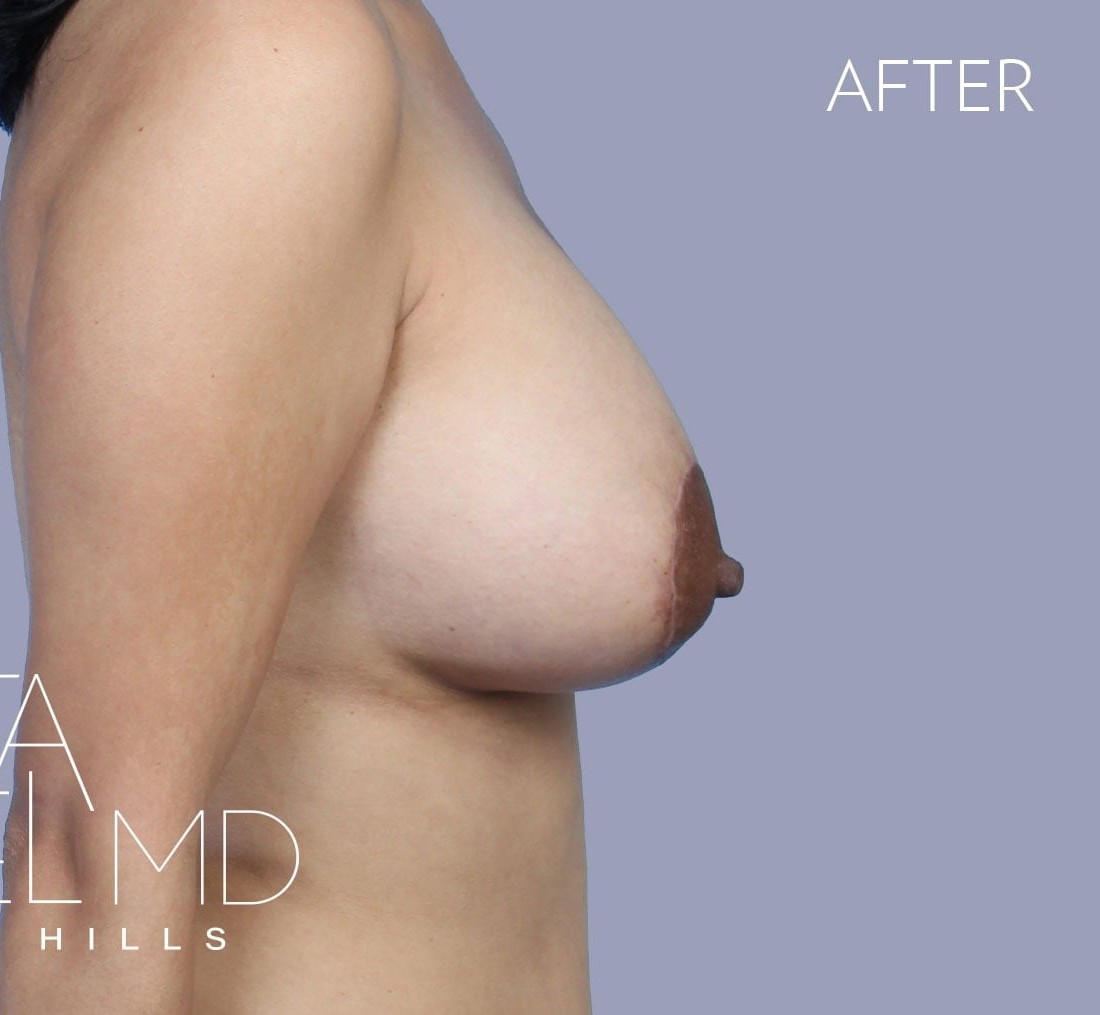 Breast Augmentation with Lift before and after - after