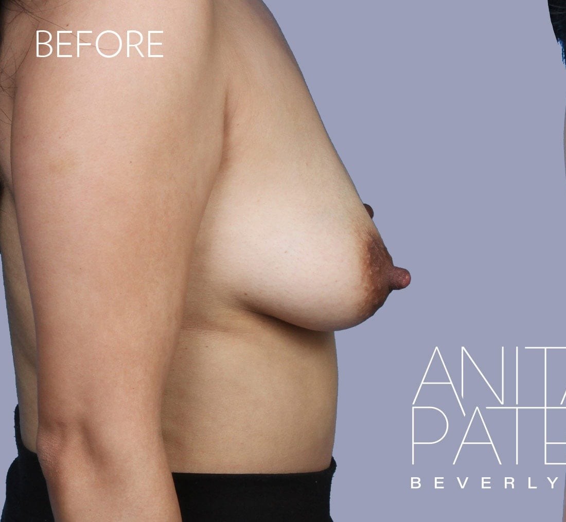 Breast Augmentation with Lift before and after - before