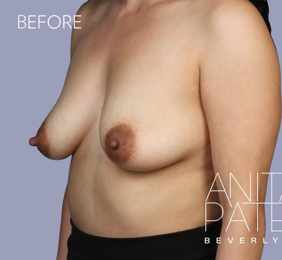 Breast Augmentation with Lift before and after - before