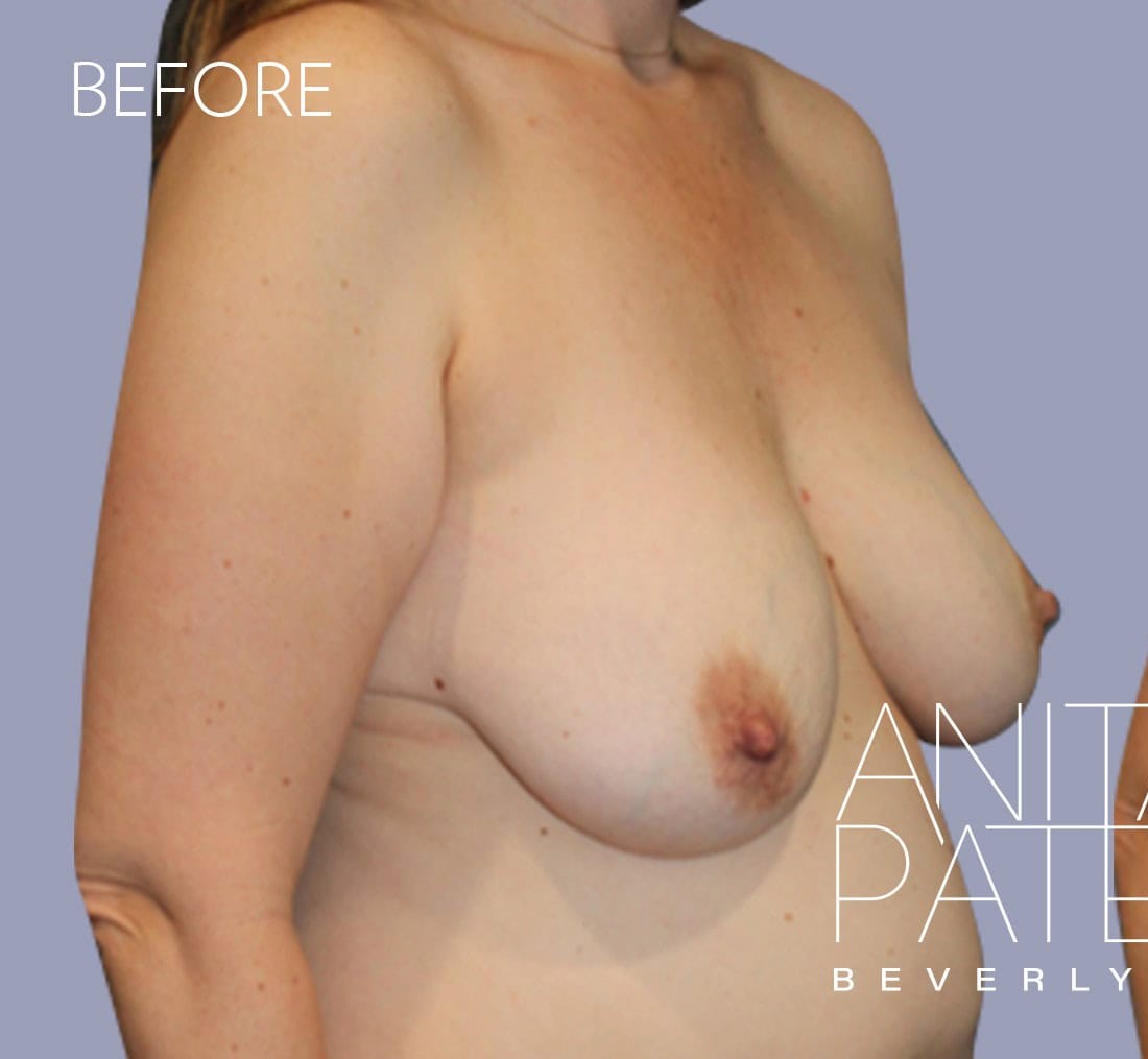 Breast Augmentation with Lift before and after - before