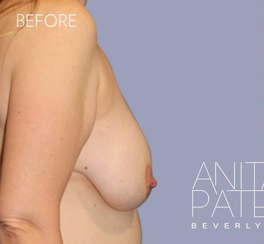 Breast Augmentation with Lift before and after - before
