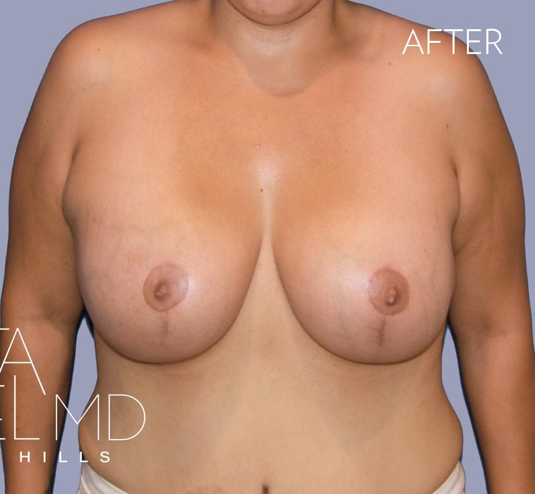 Breast Augmentation with Lift before and after - after