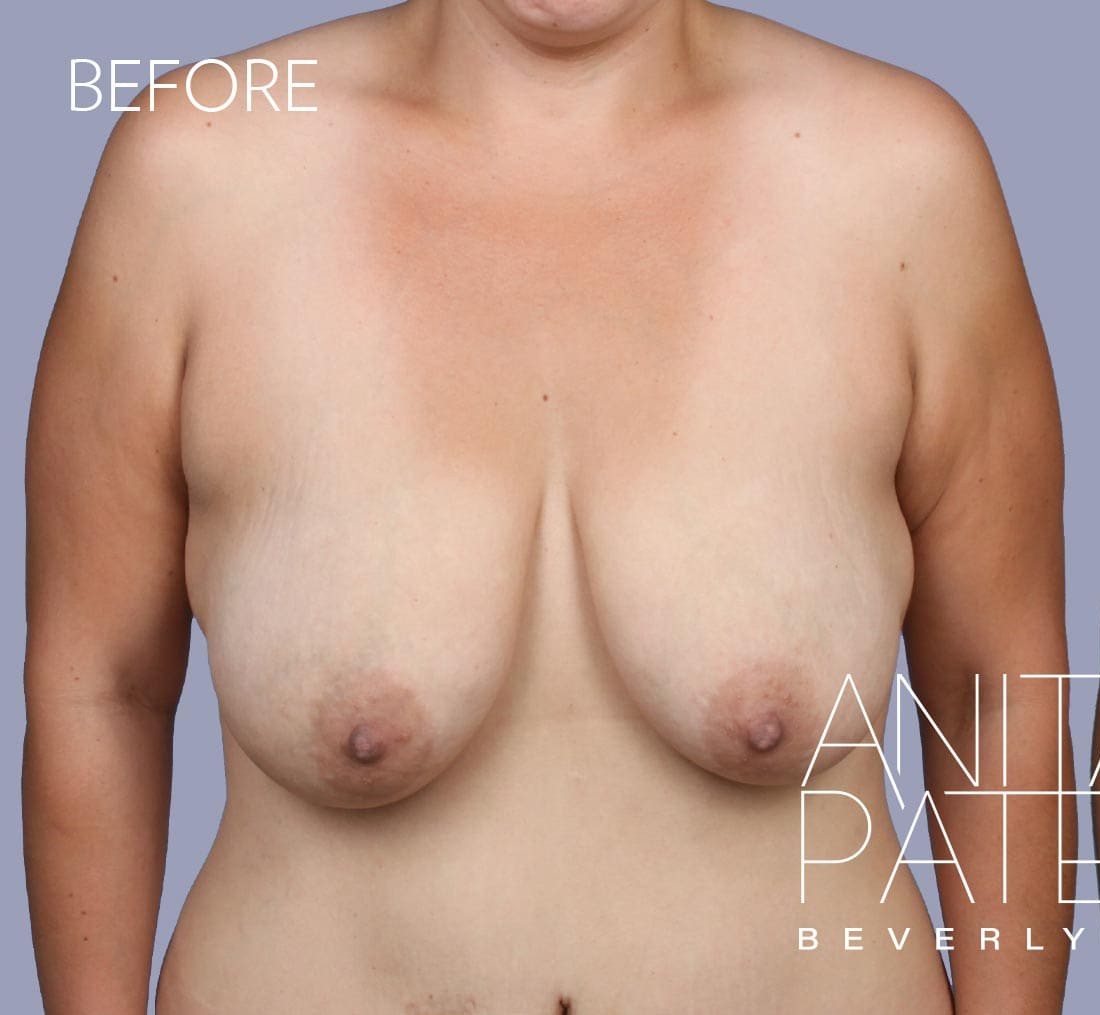 Breast Augmentation with Lift before and after - before