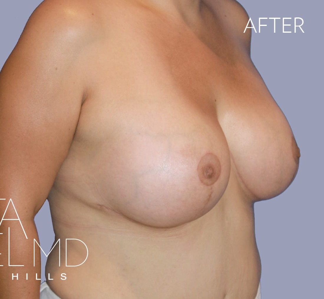 Breast Augmentation with Lift before and after - after