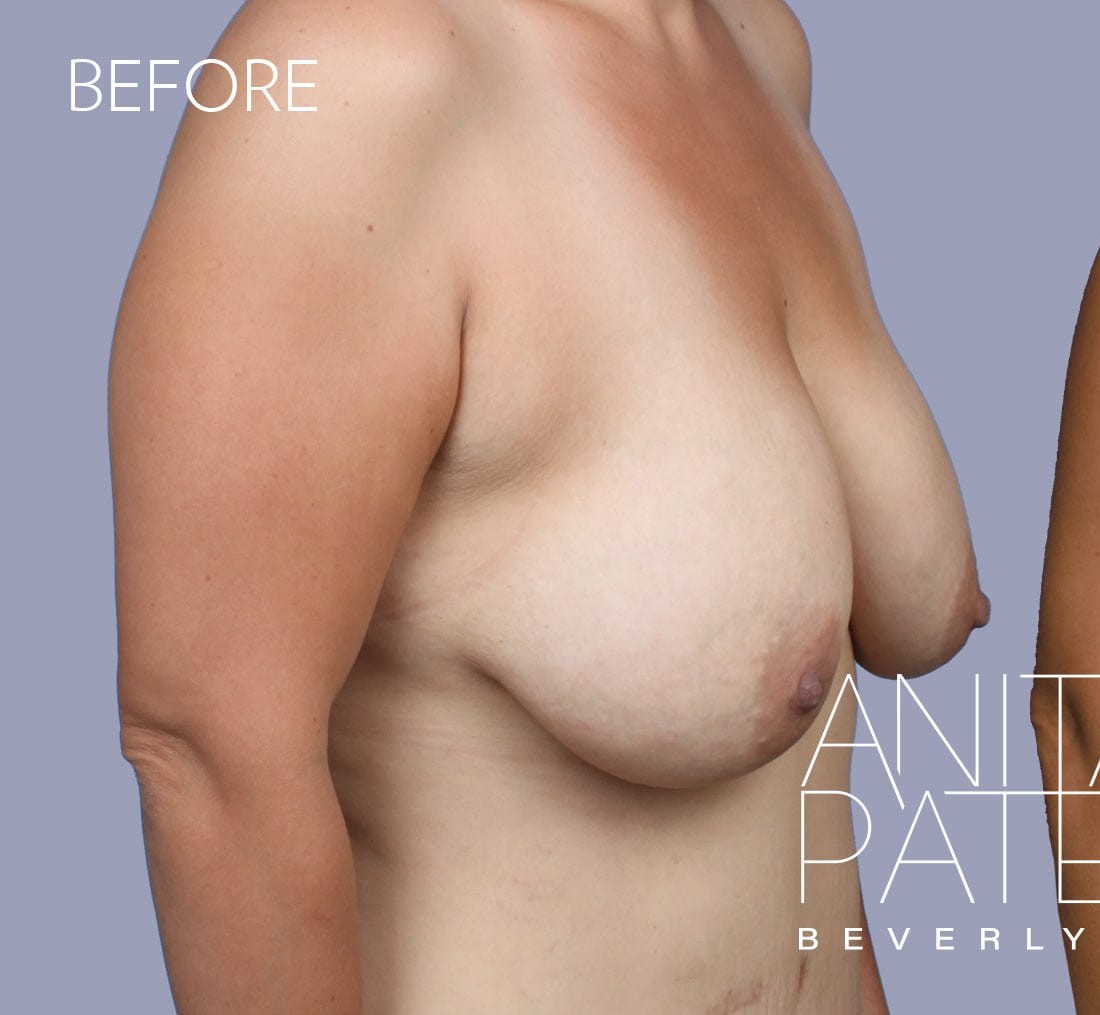 Breast Augmentation with Lift before and after - before