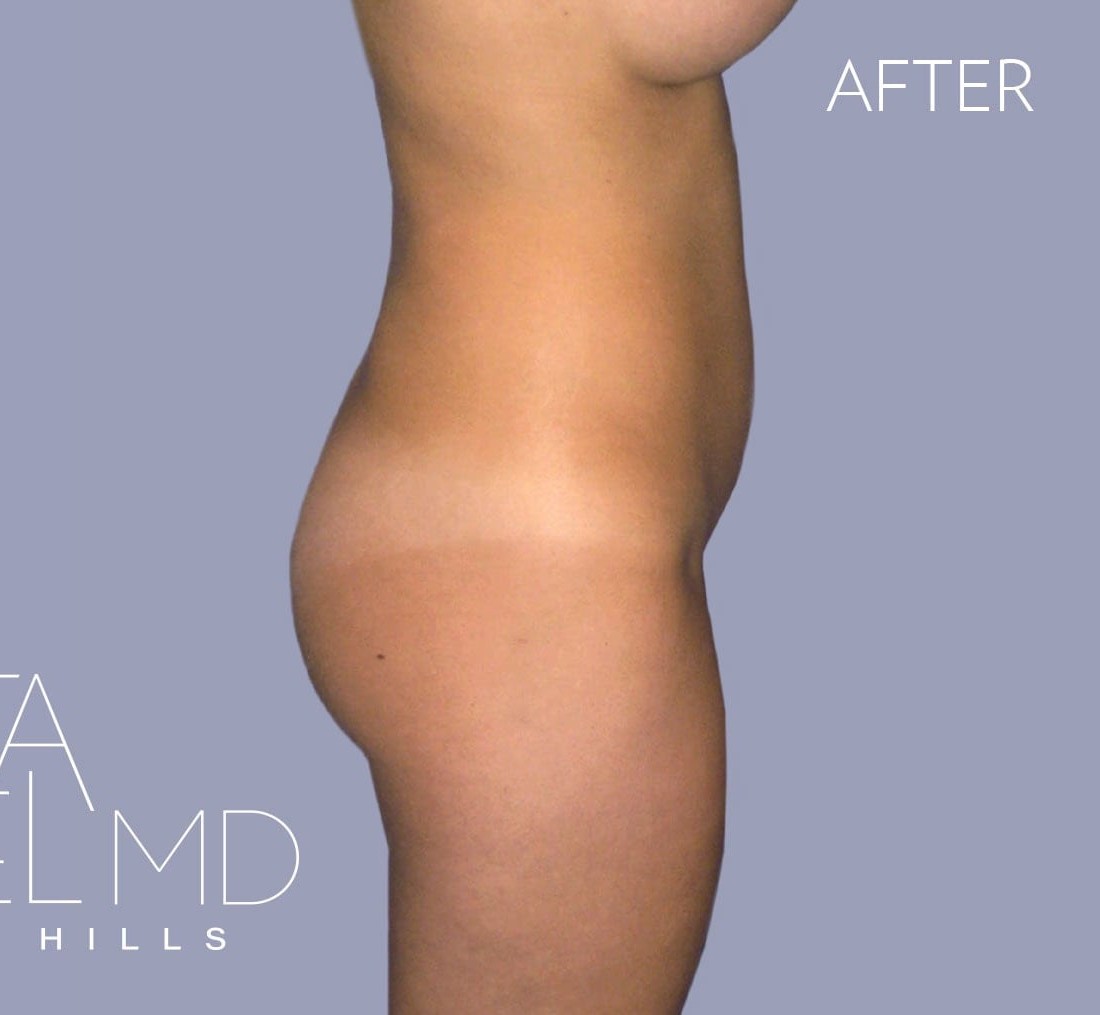 Brazilian Butt Lift before and after - after