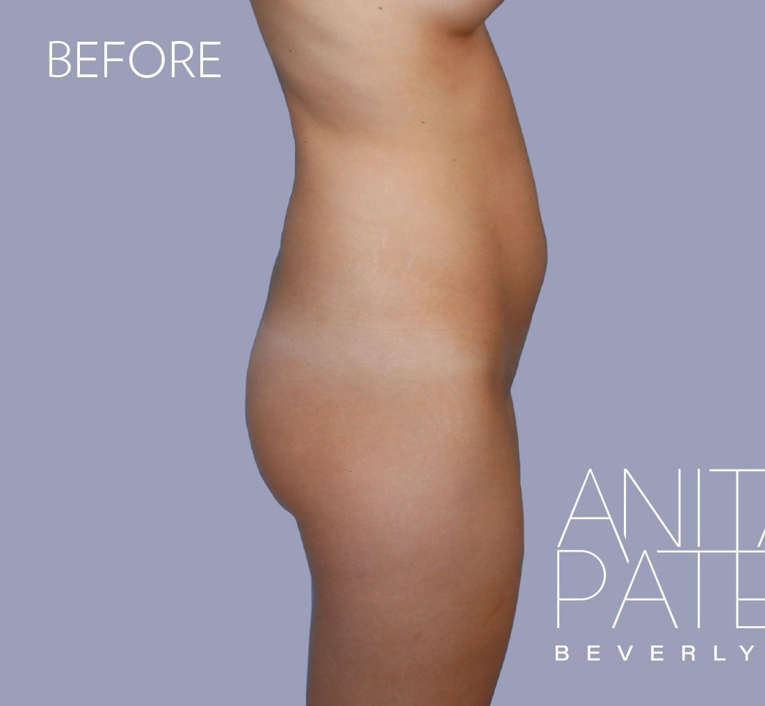 Brazilian Butt Lift before and after - before