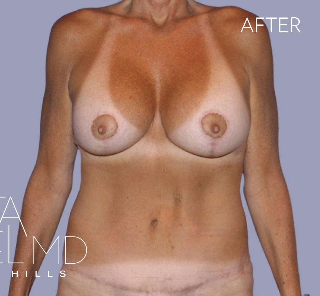 Breast Augmentation with Lift before and after - after