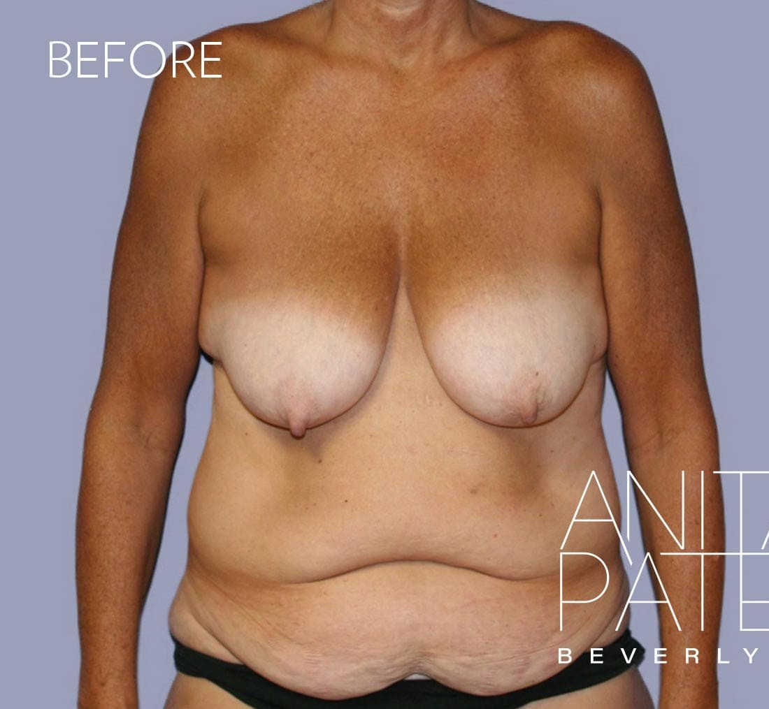 Breast Augmentation with Lift before and after - before
