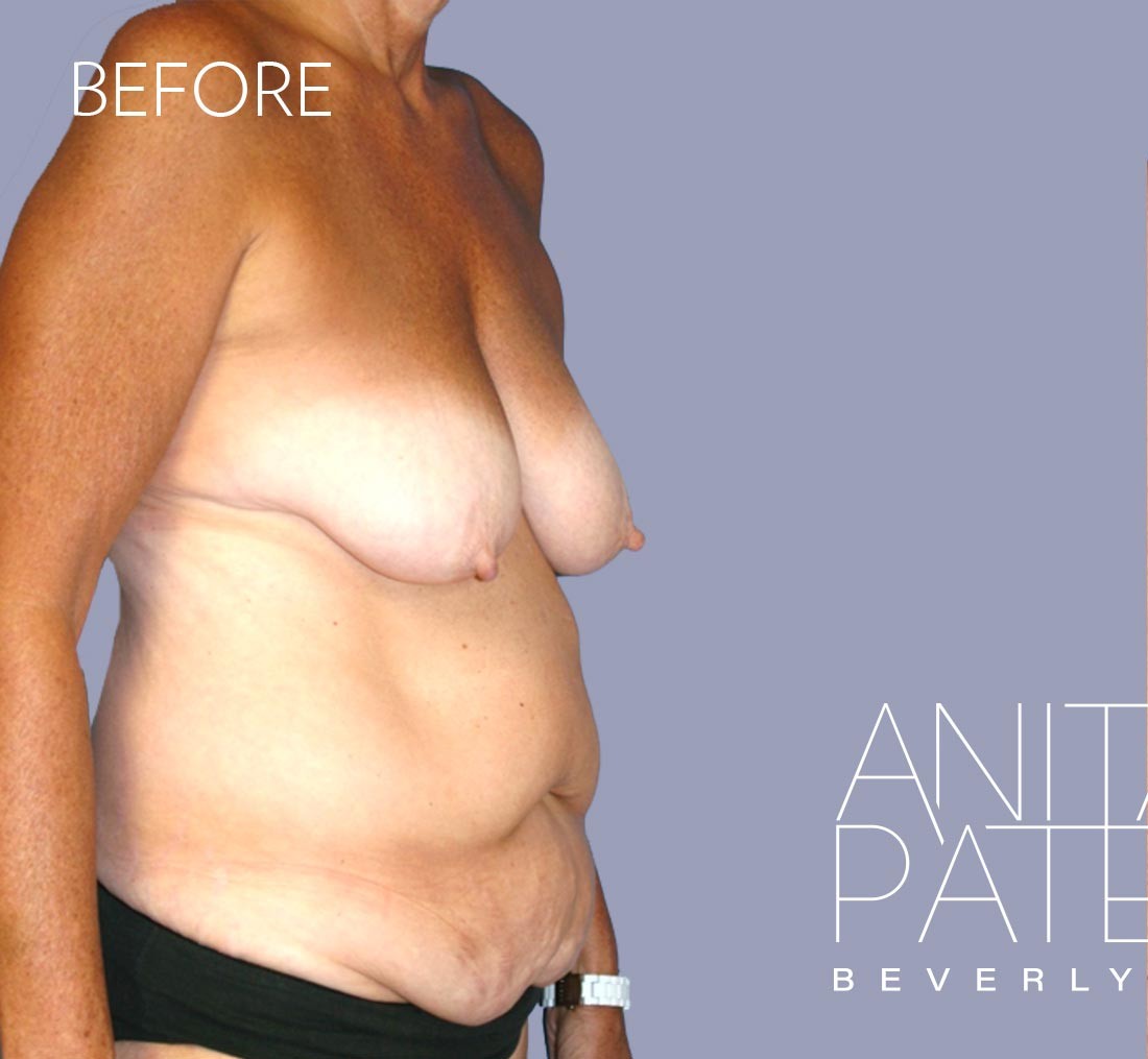Breast Augmentation with Lift before and after - before