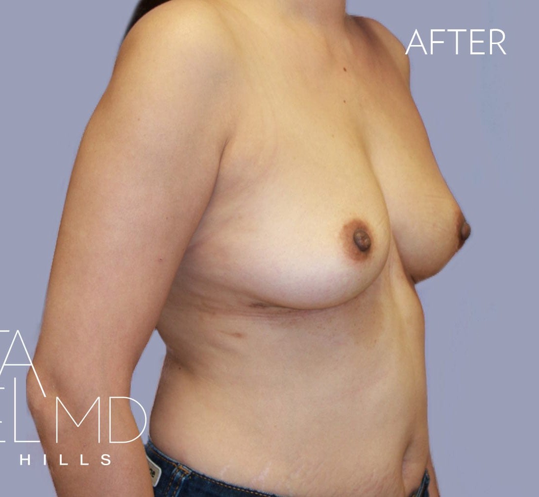 Breast Implant Removal before and after - after