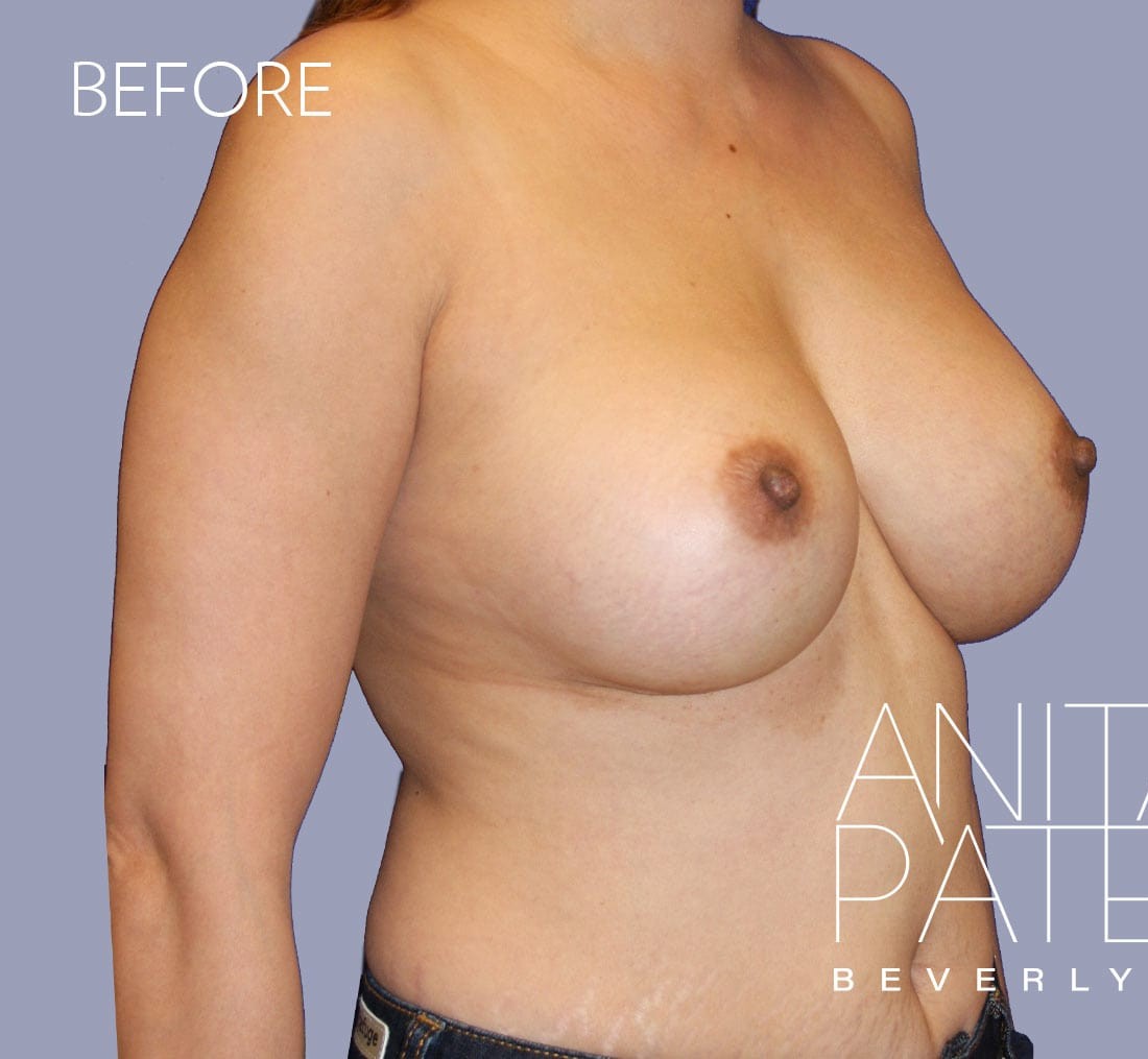 Breast Implant Removal before and after - before