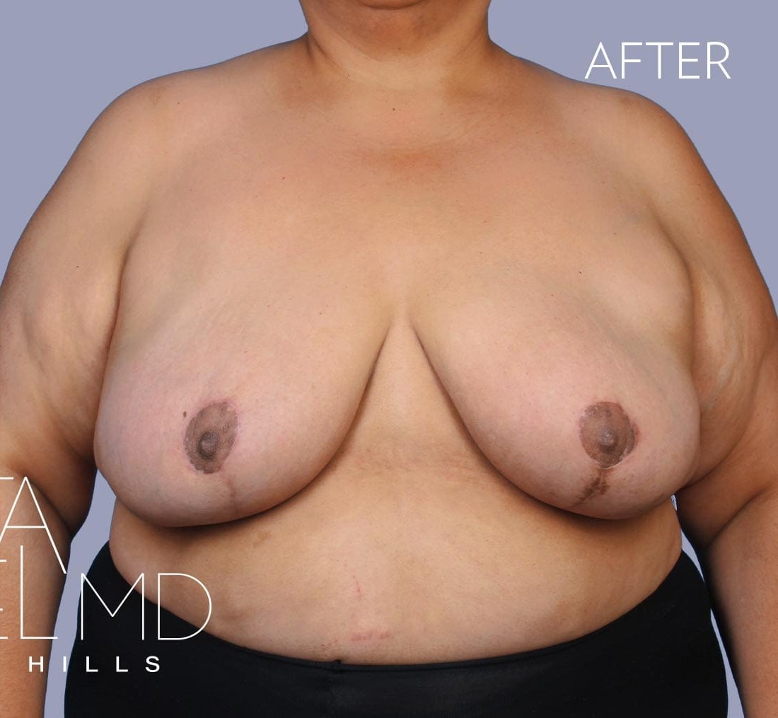 Breast Implant Removal before and after - after