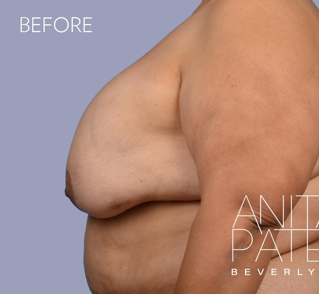 Breast Implant Removal before and after - before