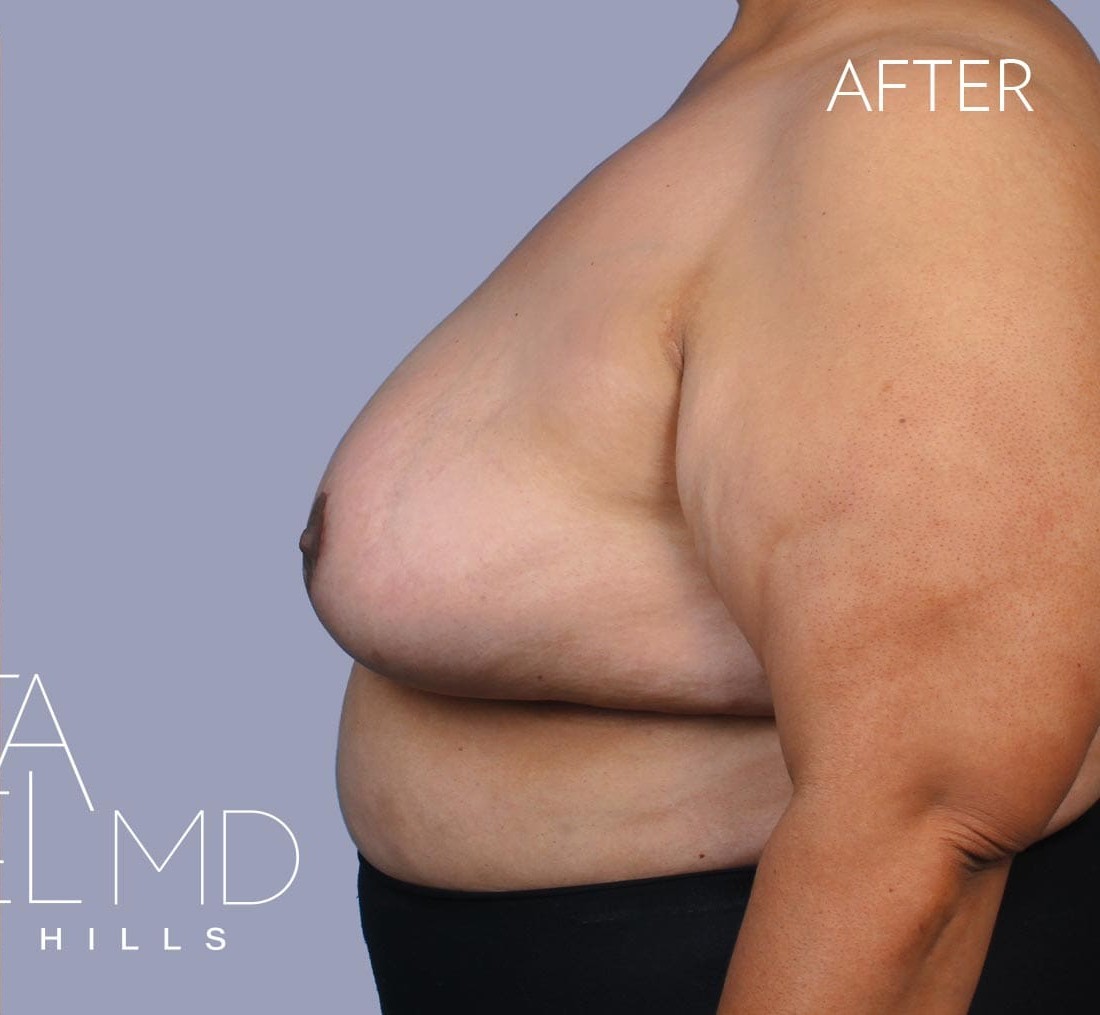 Breast Implant Removal before and after - after