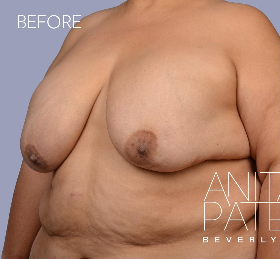 Breast Implant Removal before and after - before