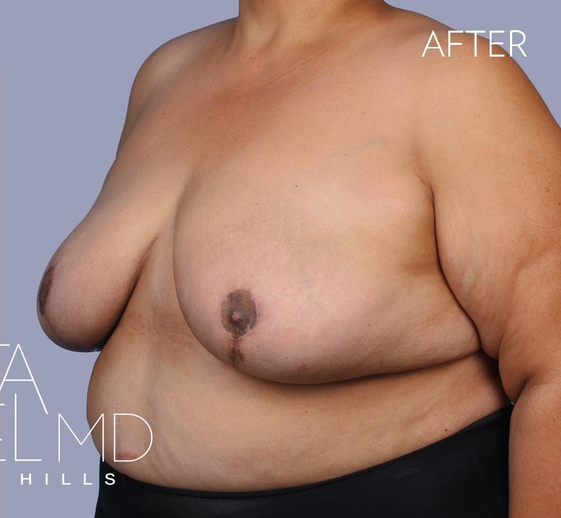 Breast Implant Removal before and after - after
