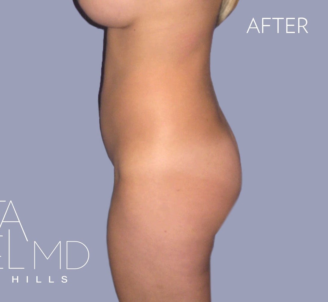 Brazilian Butt Lift before and after - after
