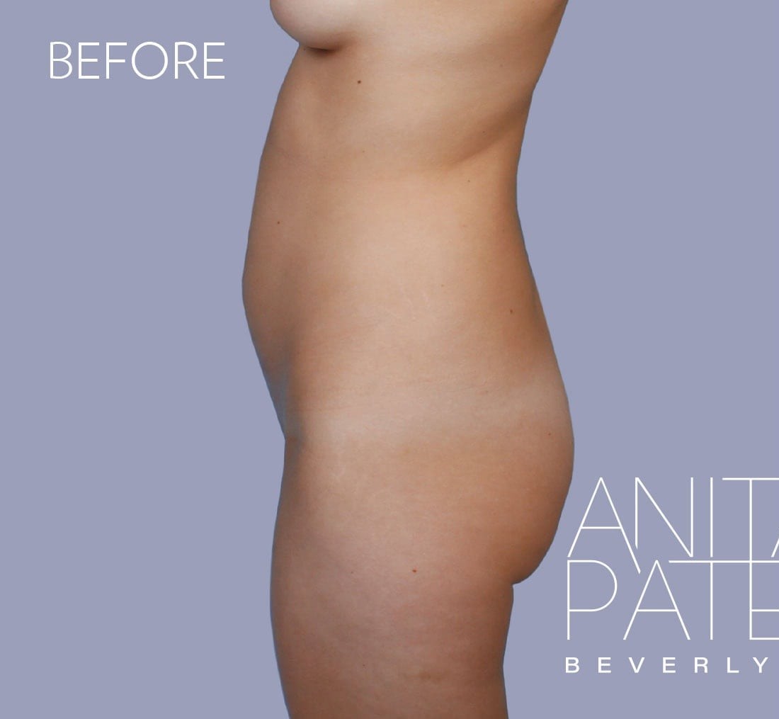 Brazilian Butt Lift before and after - before
