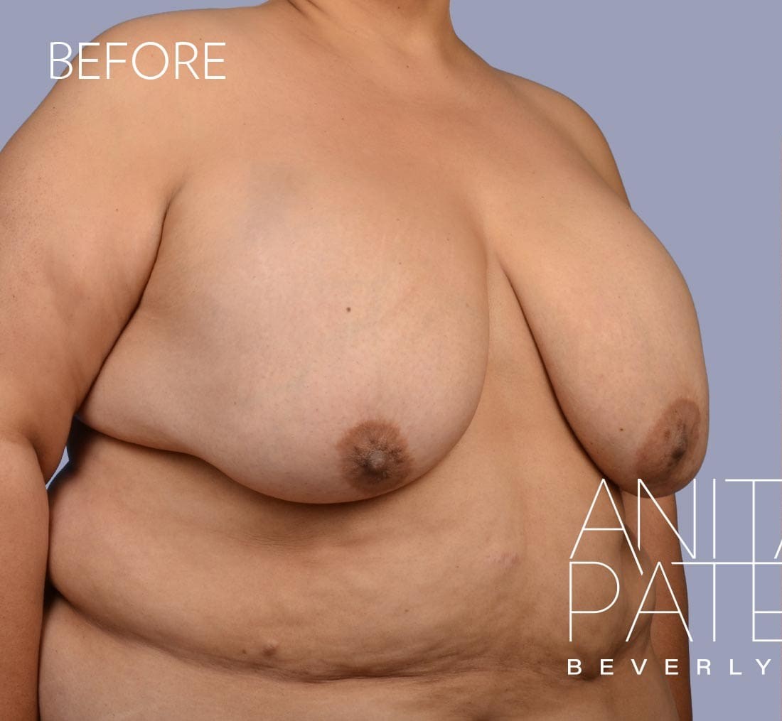 Breast Implant Removal before and after - before