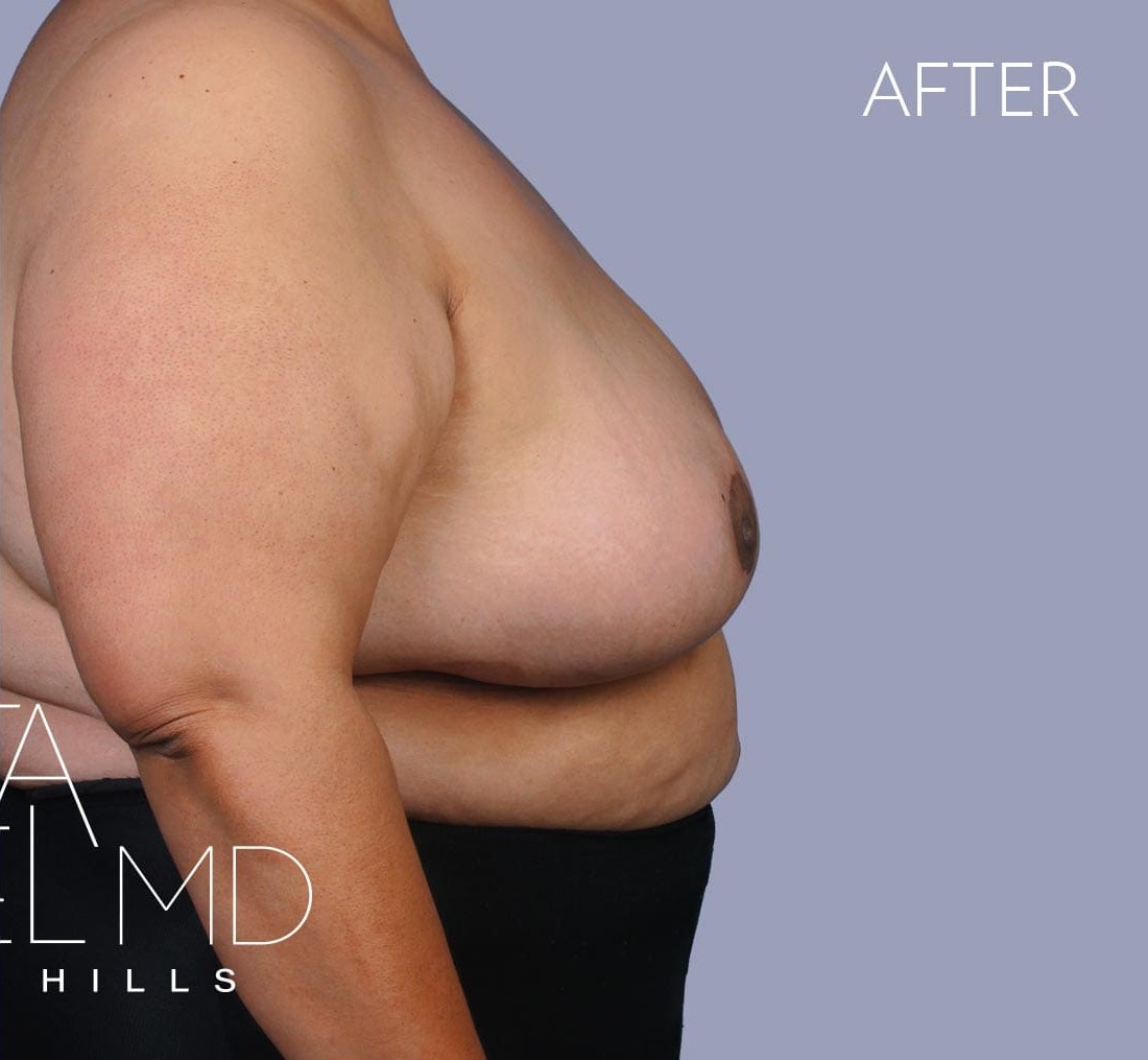 Breast Implant Removal before and after - after