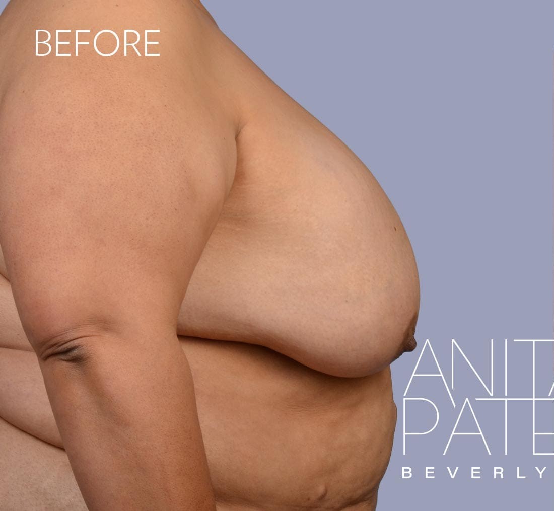 Breast Implant Removal before and after - before