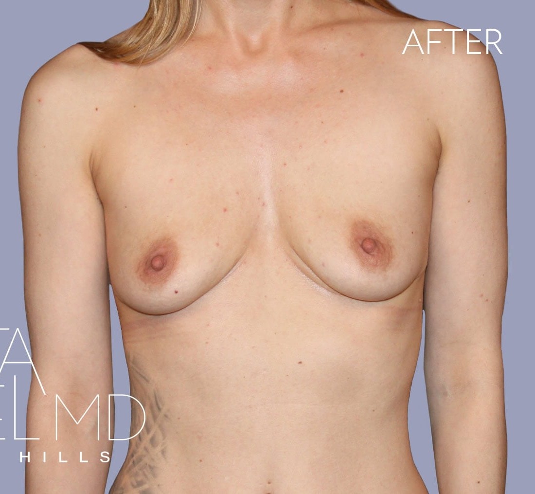 Breast Implant Removal before and after - after