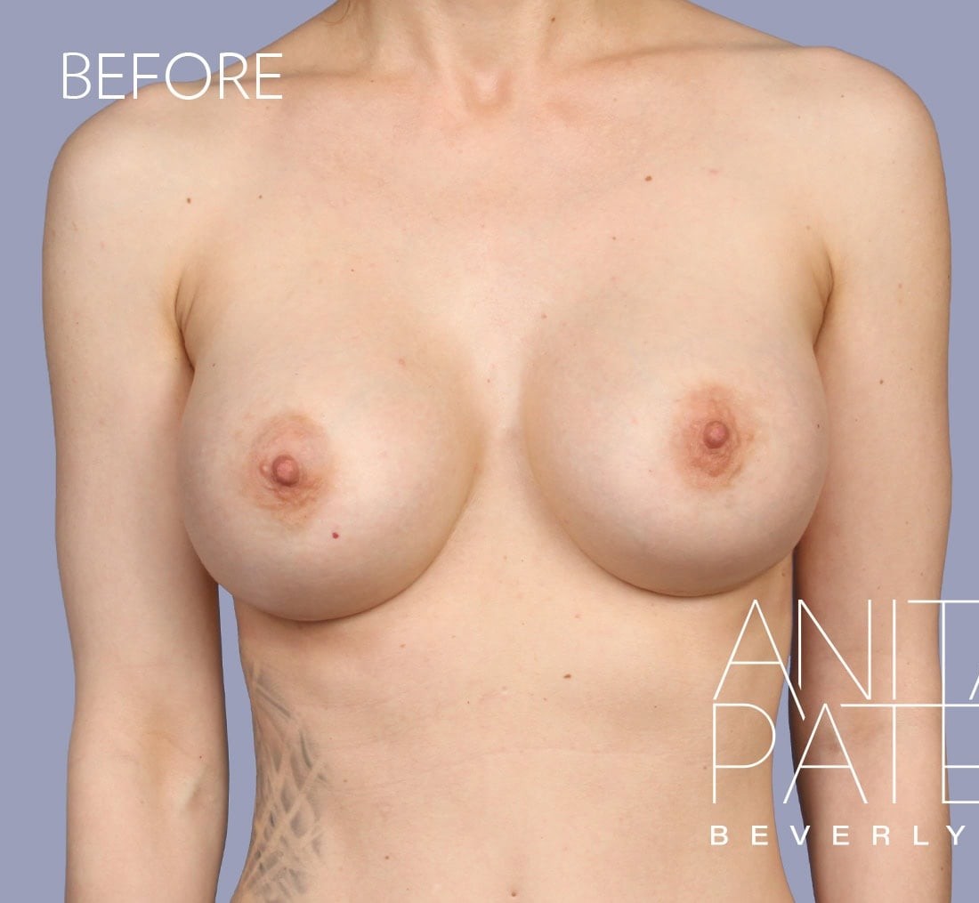 Breast Implant Removal before and after - before