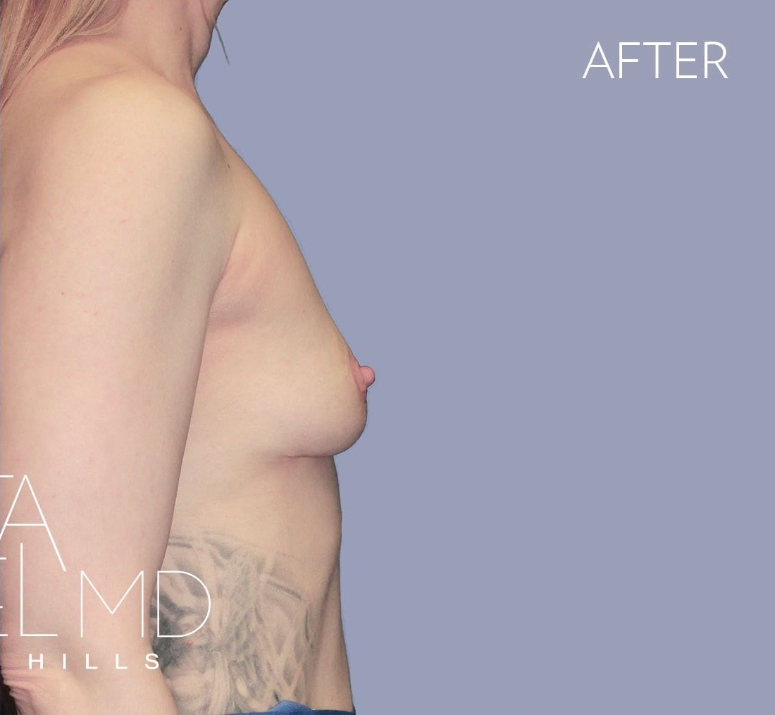 Breast Implant Removal before and after - after