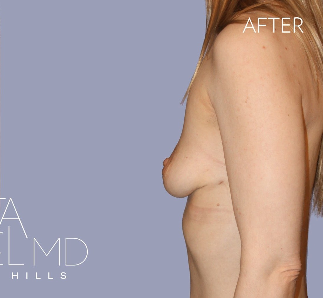 Breast Implant Removal before and after - after