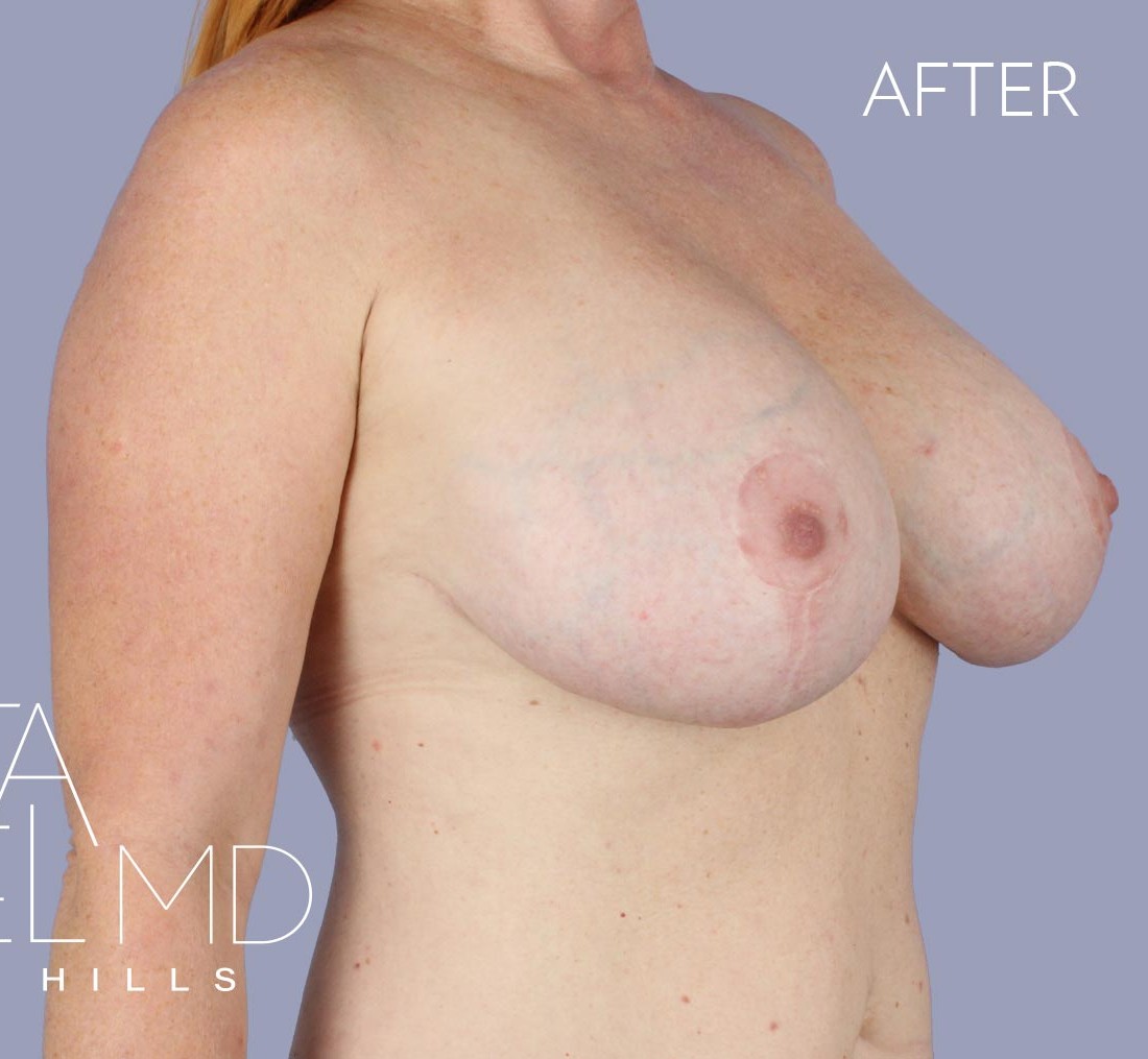 Breast Implant Replacement before and after - after