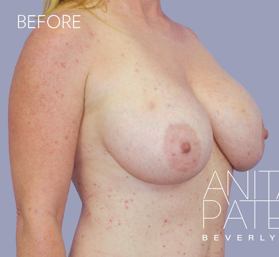 Breast Implant Replacement before and after - before