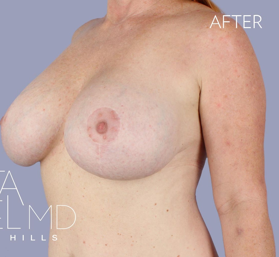 Breast Implant Replacement before and after - after