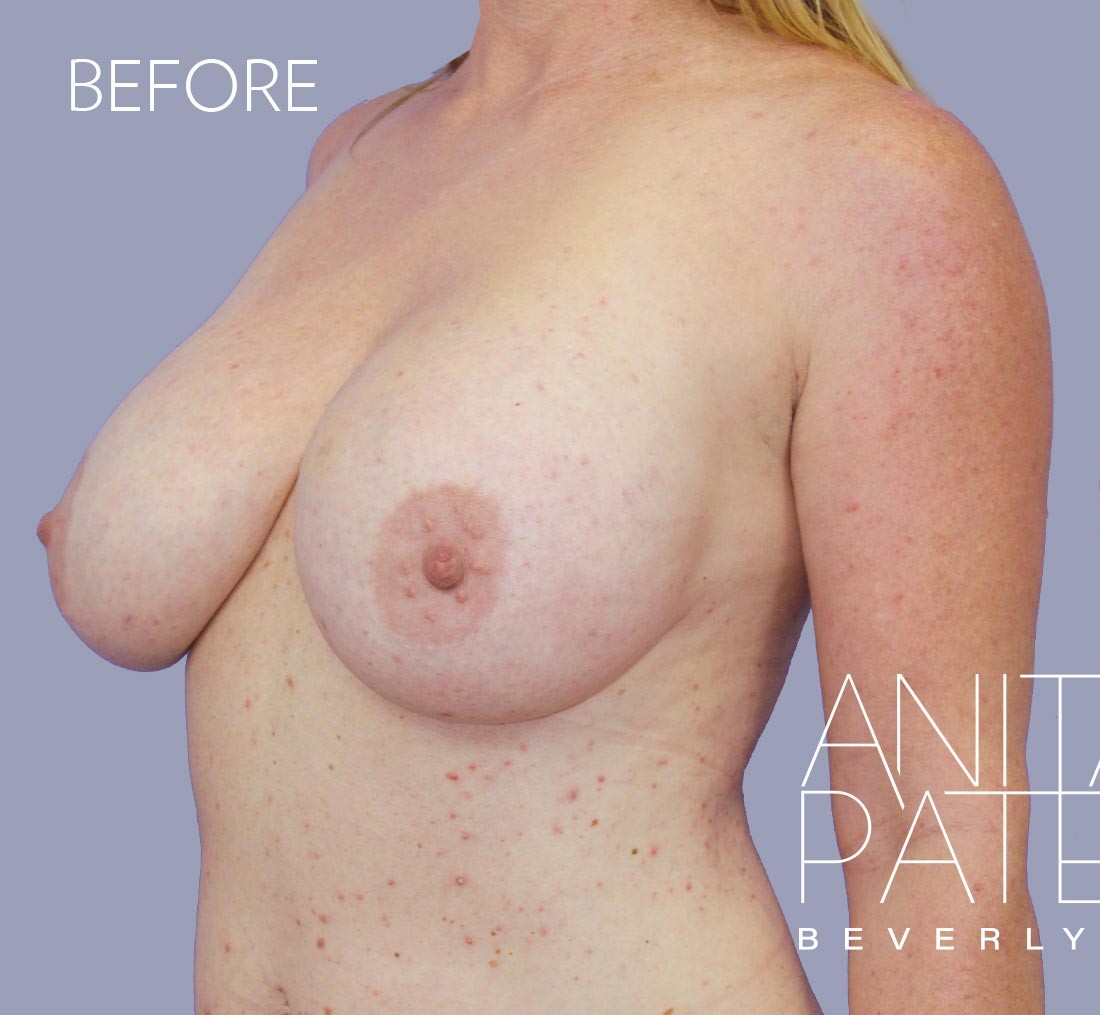 Breast Implant Replacement before and after - before