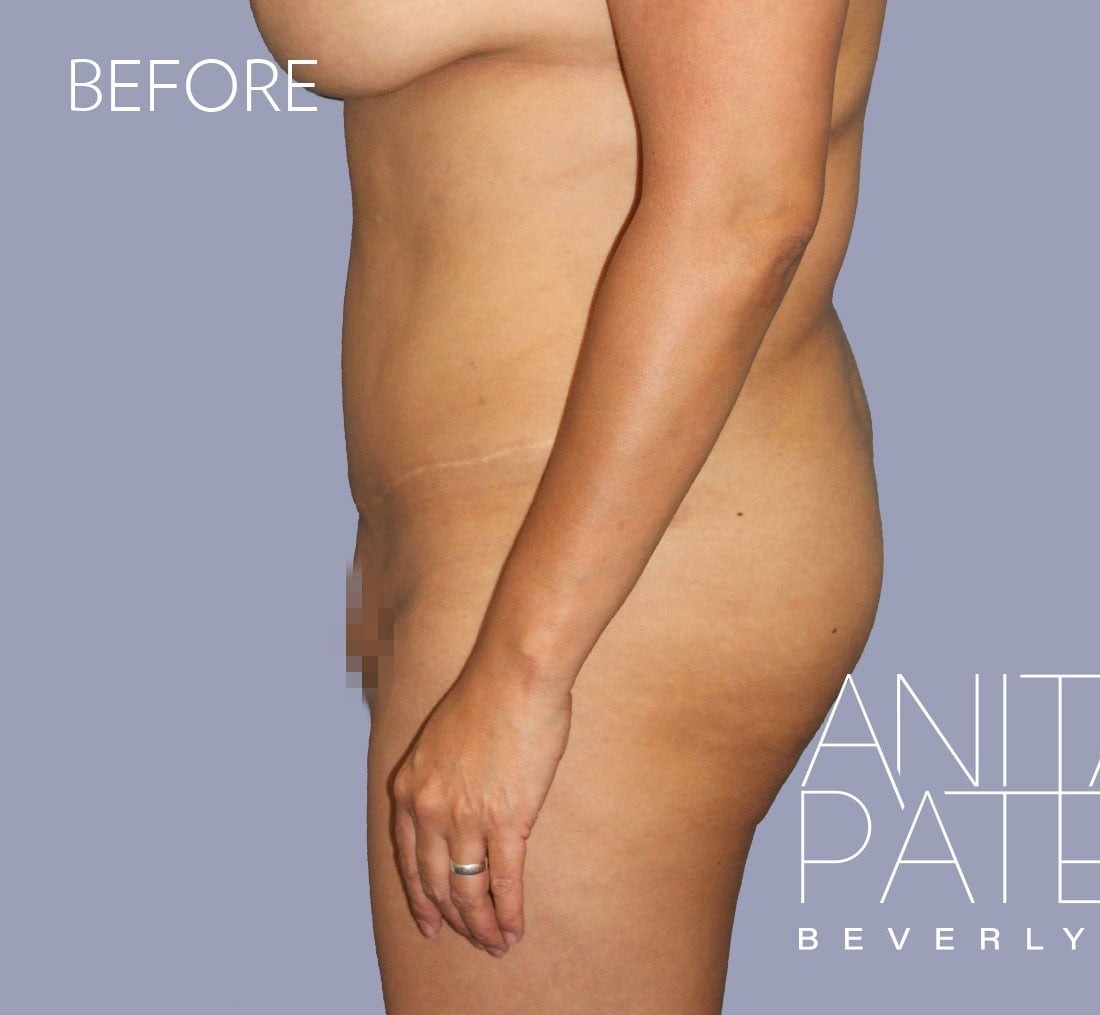 Brazilian Butt Lift before and after - before