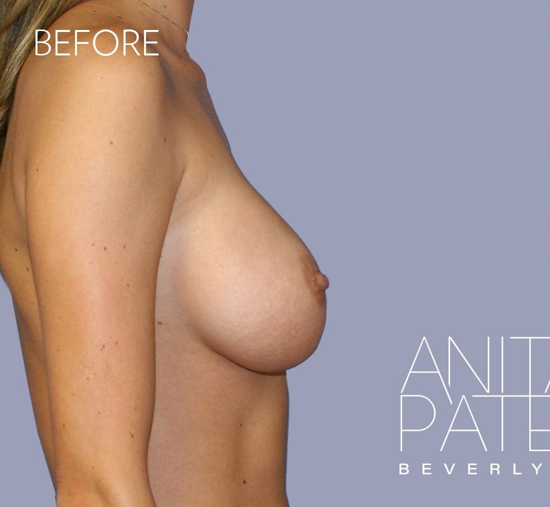 Breast Implant Replacement before and after - before
