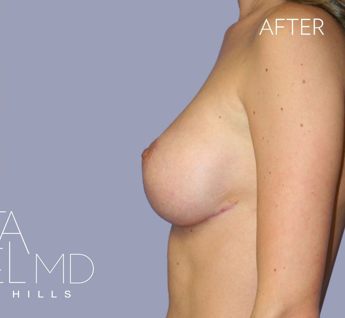 Breast Implant Replacement before and after - after