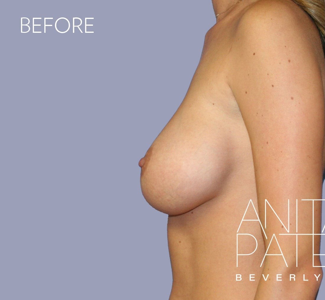 Breast Implant Replacement before and after - before