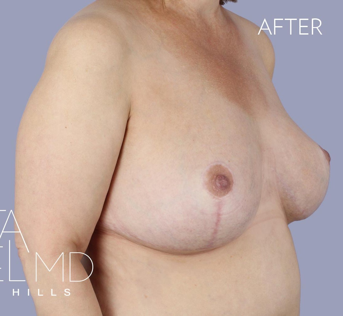 Breast Implant Replacement before and after - after