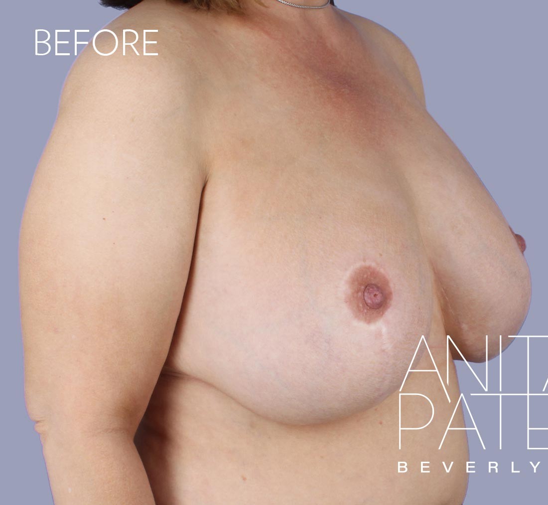Breast Implant Replacement before and after - before