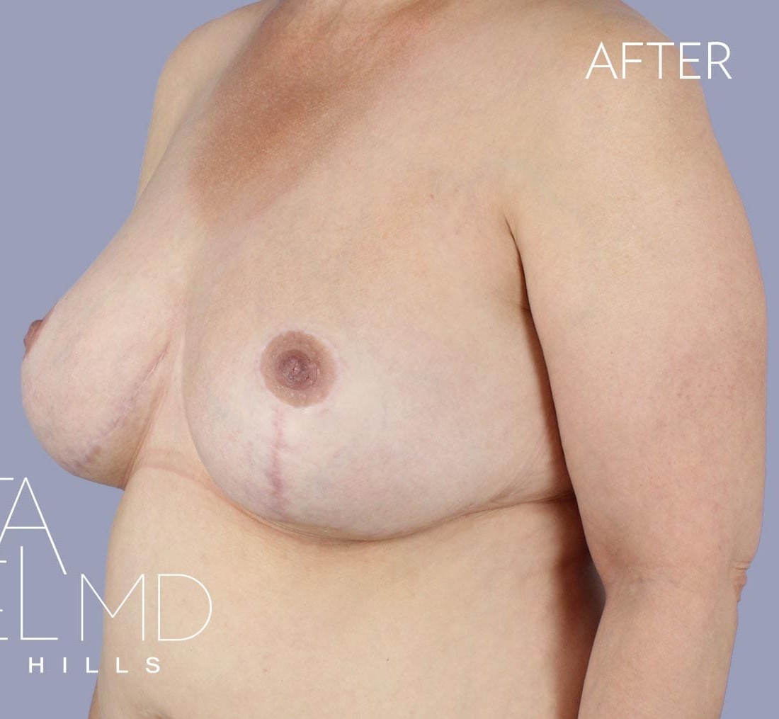 Breast Implant Replacement before and after - after