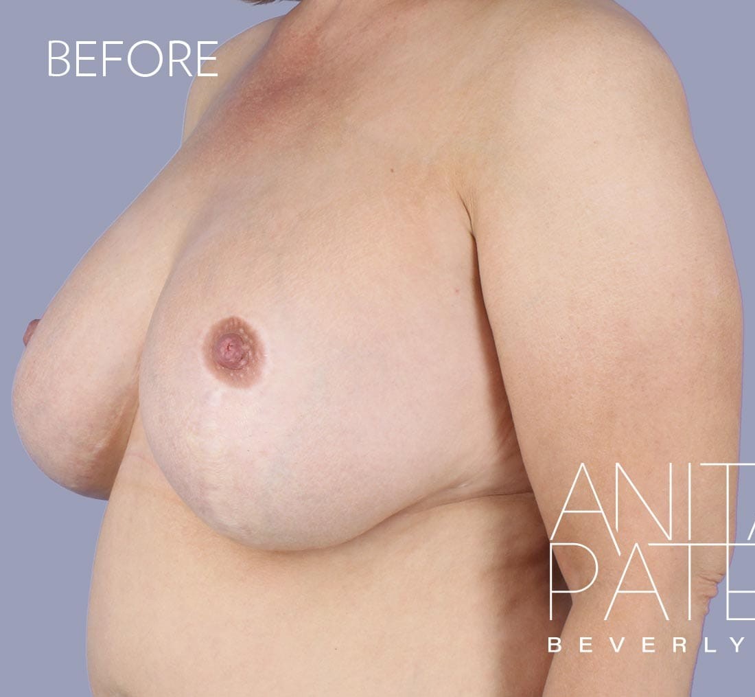 Breast Implant Replacement before and after - before