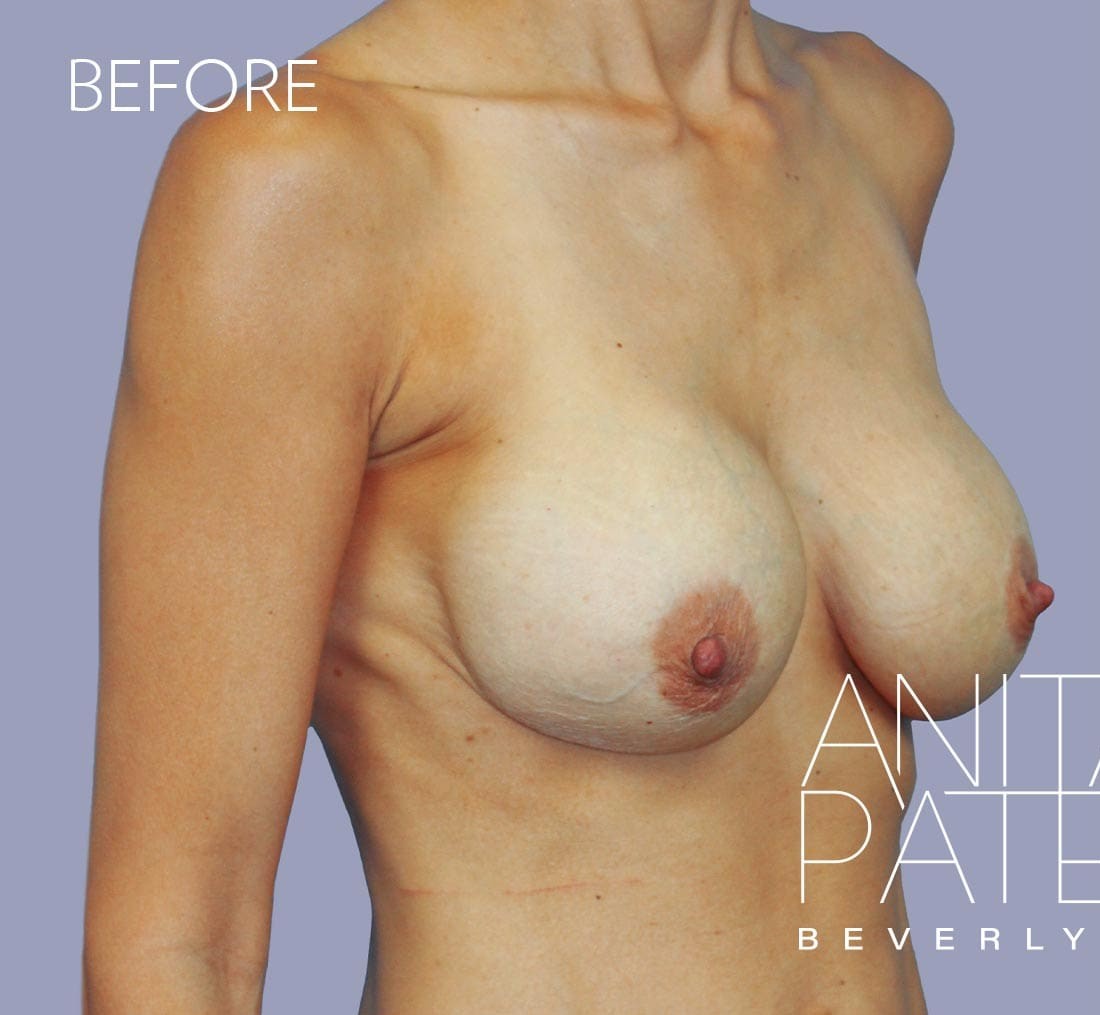 Breast Implant Replacement before and after - before