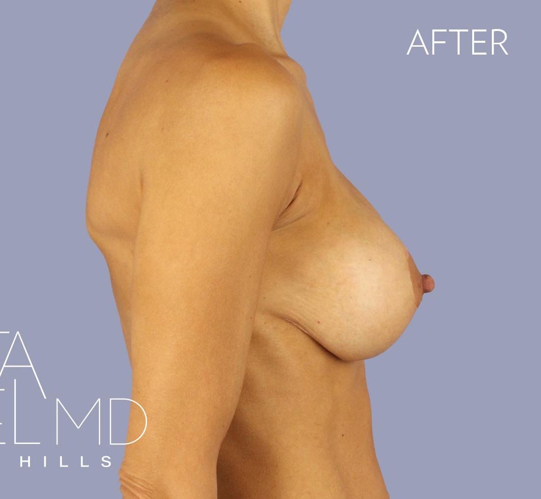 Breast Implant Replacement before and after - after