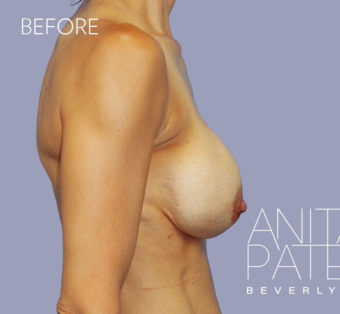 Breast Implant Replacement before and after - before