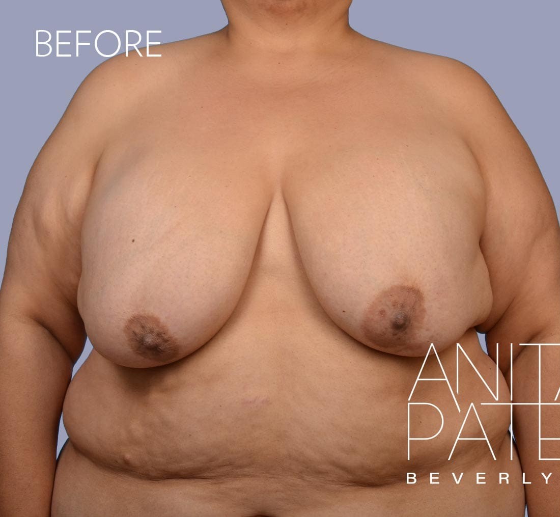 Breast Implant Replacement before and after - before