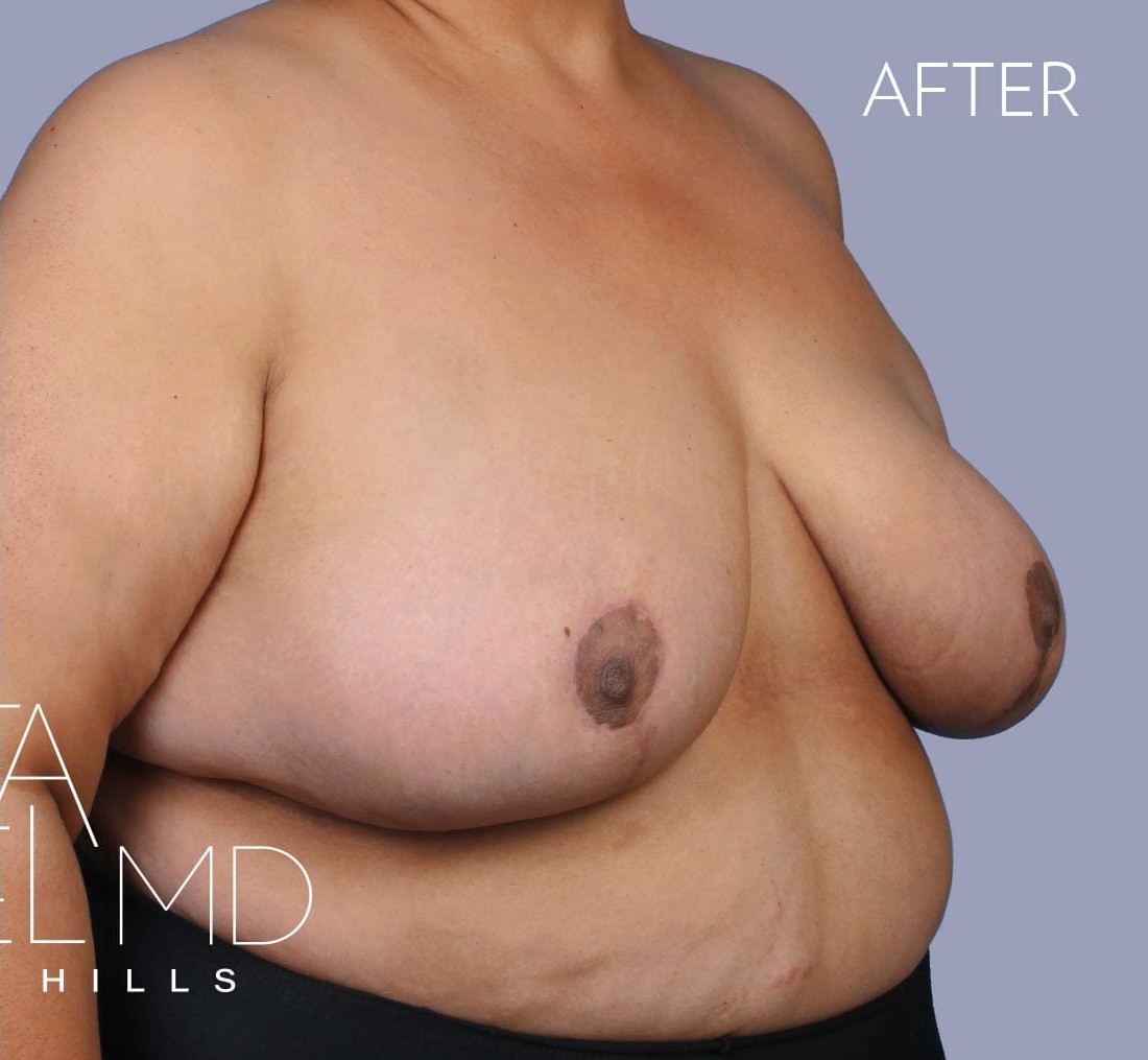 Breast Implant Replacement before and after - after