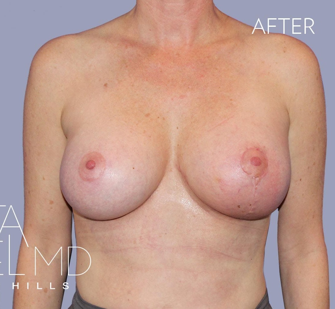 Breast Implant Replacement before and after - after